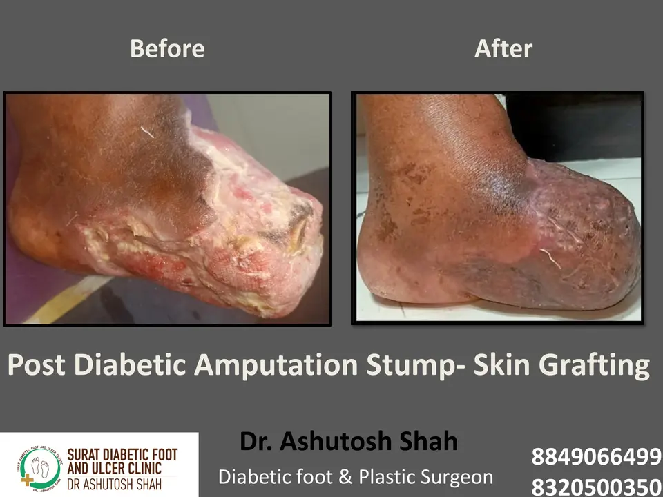 Diabetic Foot  PPT 3 checked by sir.pptx-22.webp